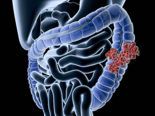 The study focuses on the Adenomatous Polyposis Coli (APC), a gene that has long been considered the gatekeeper in the development of colon cancer.
 
 