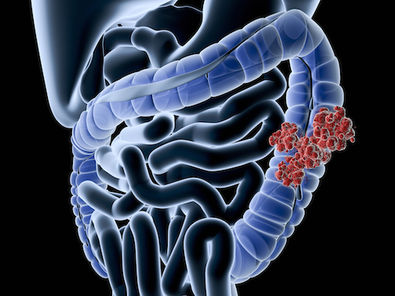 The study focuses on the Adenomatous Polyposis Coli (APC), a gene that has long been considered the gatekeeper in the development of colon cancer.
 
 