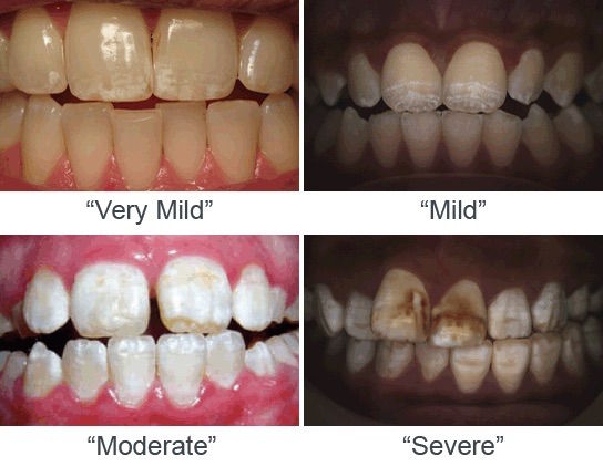 Stages of fluorosis.
 
 